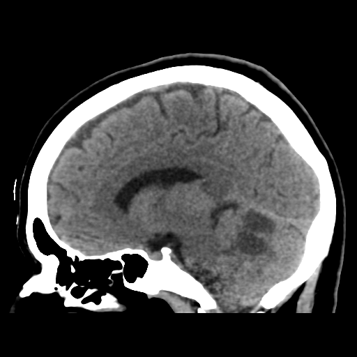File:Cerebellar metastasis (cystic appearance) (Radiopaedia 41395-44258 E 32).png