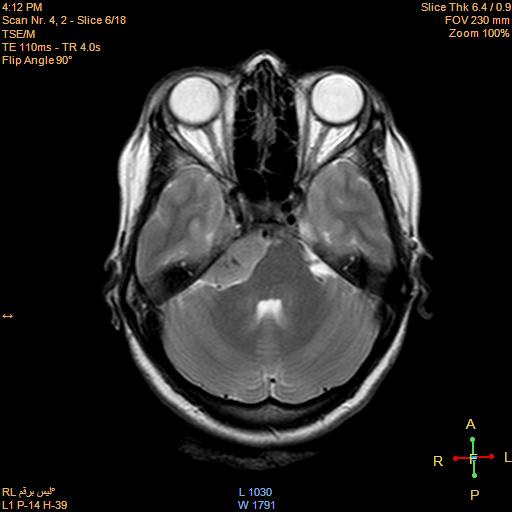File:Cerebellopontine angle meningioma (Radiopaedia 22488-22525 Axial T2 4).jpg