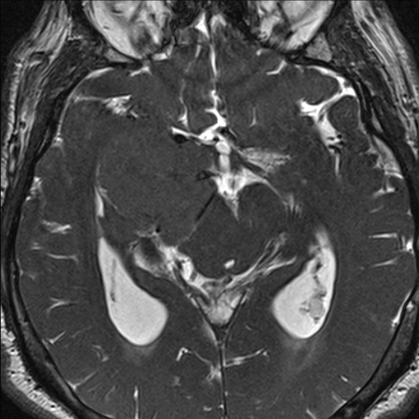 Cerebellopontine angle meningioma (Radiopaedia 24459-24764 I 45).jpg