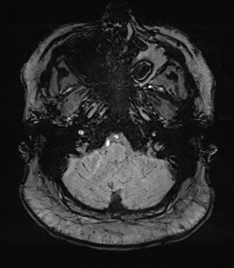 Cerebellopontine angle meningioma (Radiopaedia 48434-53348 Axial SWI 14).png