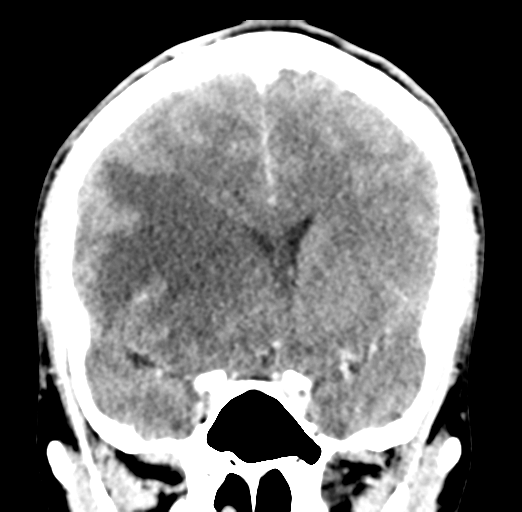 Cerebral abscess (Radiopaedia 60342-68008 Coronal C+ delayed 27).png