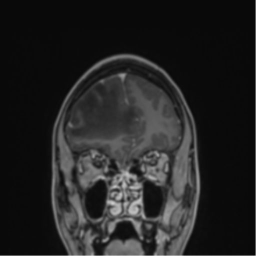 Cerebral abscess (Radiopaedia 60342-68009 H 44).png