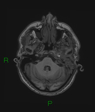 Cerebral abscess and subdural empyema (Radiopaedia 84436-99779 Axial T1 66).jpg