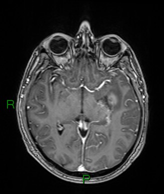 Cerebral abscess and subdural empyema (Radiopaedia 84436-99779 Axial T1 C+ 48).jpg