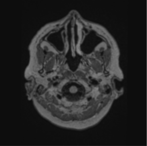 Cerebral abscess from pulmonary arteriovenous malformation (Radiopaedia 86275-102291 J 9).png