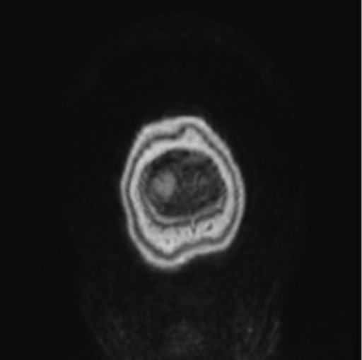 File:Cerebral abscess from pulmonary arteriovenous malformation (Radiopaedia 86275-102291 L 4).png
