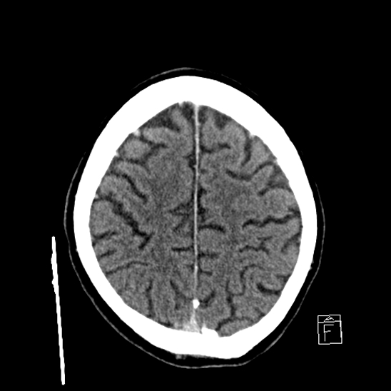 File:Cerebral abscess with ventriculitis (Radiopaedia 78965-91877 A 37).jpg