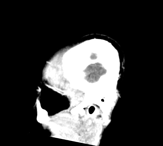 Cerebral abscesses (Radiopaedia 70458-80568 Sagittal Contrast 49).jpg