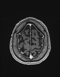 Cerebral amyloid angiopathy-related inflammation (Radiopaedia 58270-65377 Axial T1 C+ fat sat 132).jpg