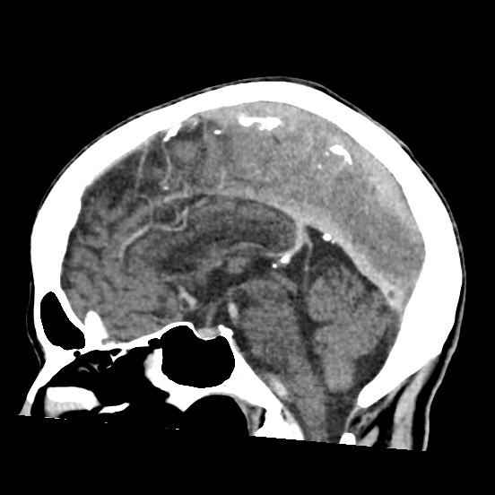 Cerebral amyloid angiopathy-related inflammation (Radiopaedia 74836-85848 C 31).jpg