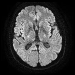 File:Cerebral amyloid angiopathy (Radiopaedia 28698-28978 Axial DWI 15).jpg