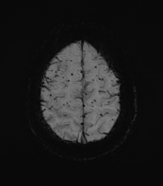 File:Cerebral amyloid angiopathy (Radiopaedia 46082-50433 Axial SWI MIP 67).png