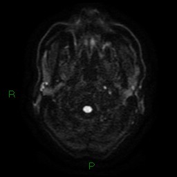Cerebral amyloid angiopathy (Radiopaedia 77506-89664 Axial DWI 2).jpg