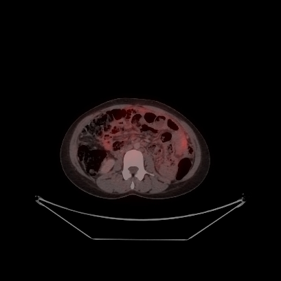 File:Cerebral and abdominal tuberculosis (Radiopaedia 90499-107853 C 174).jpg