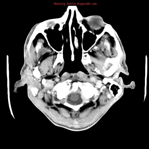File:Cerebral and orbital tuberculomas (Radiopaedia 13308-13310 B 3).jpg