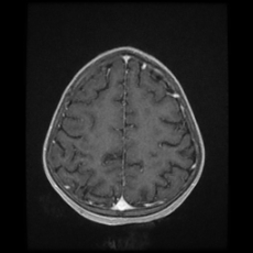Cerebral and spinal tuberculosis (Radiopaedia 90489-107837 Axial T1 C+ 151).jpg
