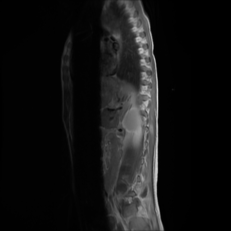 File:Cerebral and spinal tuberculosis (Radiopaedia 90489-107912 Sagittal T1 C+ 1).jpg