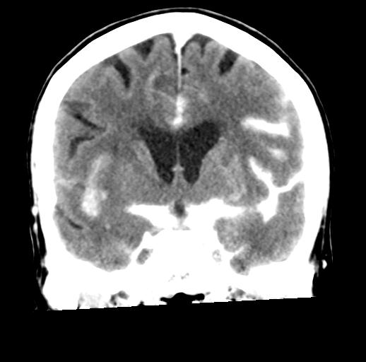 File:Cerebral aneurysm with rupture (Radiopaedia 29933-30460 Coronal non-contrast 16).jpg