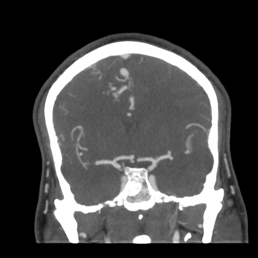 Cerebral arteriovenous malformation (Radiopaedia 39259-41505 E 29).png