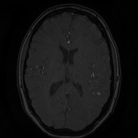 Cerebral arteriovenous malformation (Radiopaedia 74411-85654 Axial MRA 89).jpg