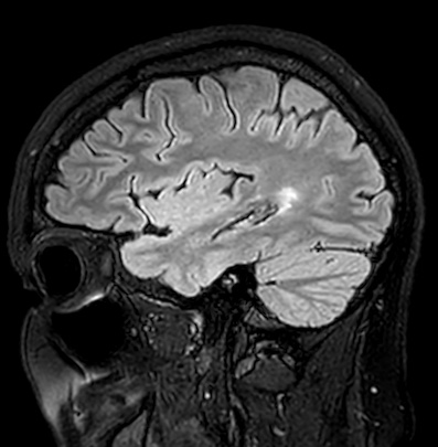 File:Cerebral arteriovenous malformation (Radiopaedia 74411-85746 Sagittal FLAIR 27).jpg