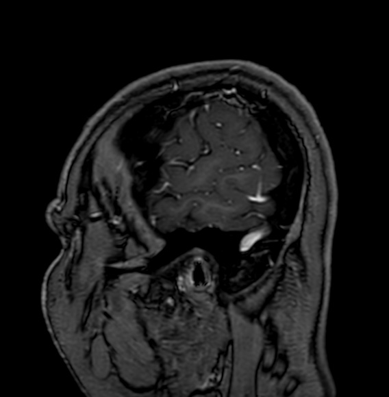 Cerebral arteriovenous malformation (Radiopaedia 74411-85746 Sagittal T1 C+ 7).jpg