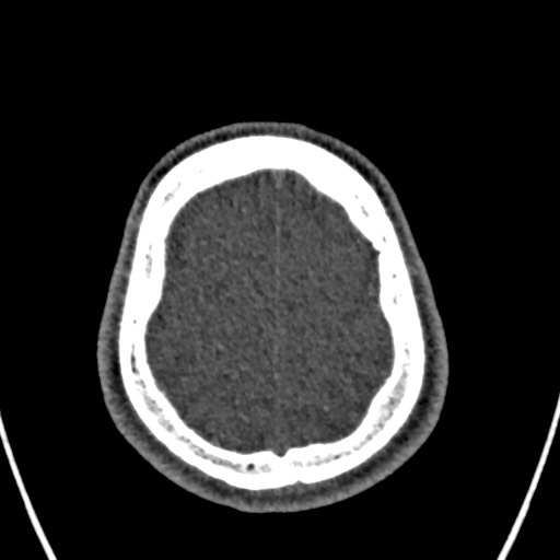 Cerebral arteriovenous malformation (Radiopaedia 78188-90746 Axial non-contrast 155).jpg