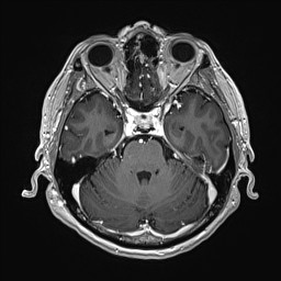 Cerebral arteriovenous malformation (Radiopaedia 84015-99245 Axial T1 C+ 55).jpg