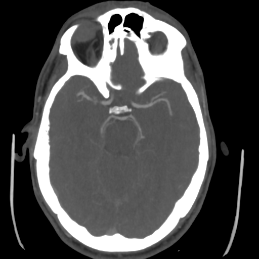 Cerebral arteriovenous malformation (Spetzler-Martin grade 2) (Radiopaedia 41262-44076 E 21).png