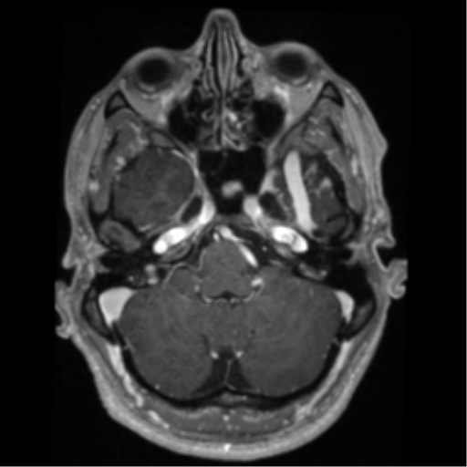 Cerebral arteriovenous malformation - huge (Radiopaedia 35734-37272 Axial T1 C+ 14).png