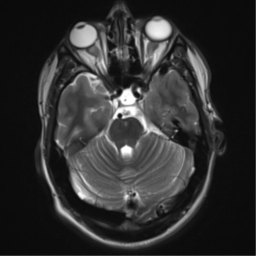 File:Cerebral arteriovenous malformation - huge (Radiopaedia 35734-37272 Axial T2 7).png
