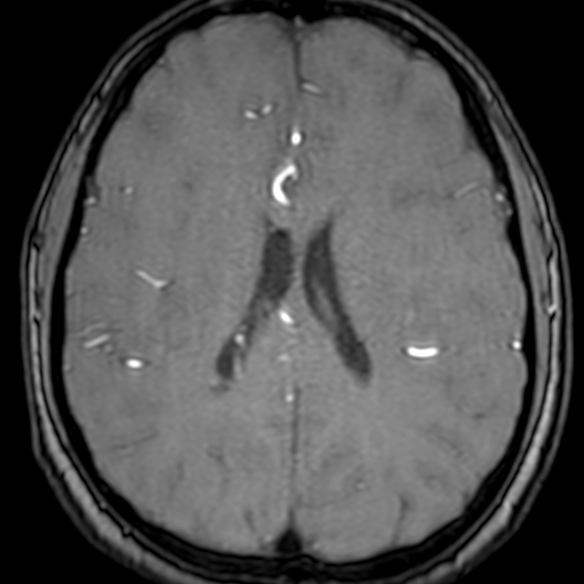 Cerebral arteriovenous malformation at posterior body of corpus callosum (Radiopaedia 74111-84925 Axial MRA 136).jpg