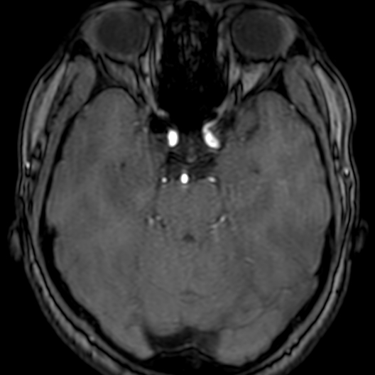 Cerebral arteriovenous malformation at posterior body of corpus callosum (Radiopaedia 74111-84925 Axial MRA 68).jpg