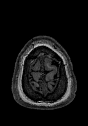 Cerebral arteriovenous malformation at posterior body of corpus callosum (Radiopaedia 74111-84925 Axial T1 2).jpg
