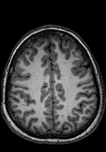 File:Cerebral arteriovenous malformation at posterior body of corpus callosum (Radiopaedia 74111-84925 Axial T1 75).jpg