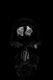 Cerebral arteriovenous malformation at posterior body of corpus callosum (Radiopaedia 74111-84925 Coronal T2 1).jpg