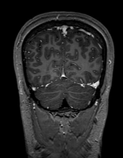 Cerebral arteriovenous malformation at posterior body of corpus callosum (Radiopaedia 74111-84925 K 311).jpg