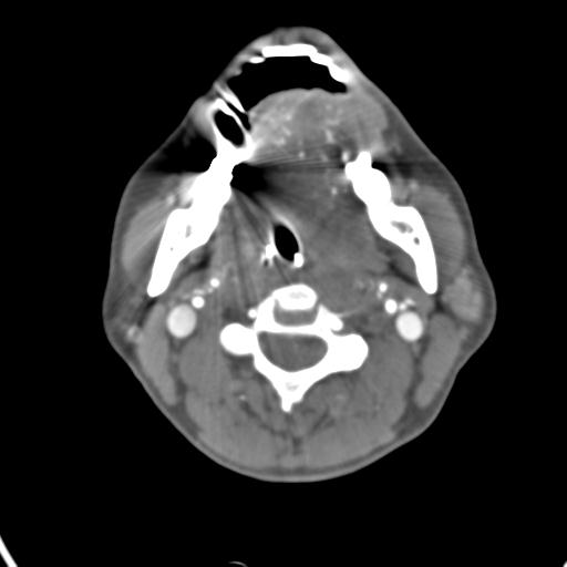 Cerebral arteriovenous malformation with hemorrhage (Radiopaedia 28773-29073 A 62).jpg