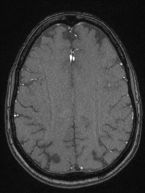 Cerebral arteriovenous malformation with hemorrhage (Radiopaedia 34422-35737 Axial MRA 59).png