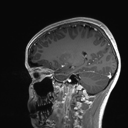 Cerebral cavernous venous malformation (Radiopaedia 70008-80021 Sagittal T1 C+ 47).jpg