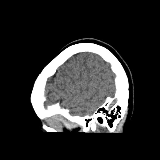 Cerebral cavernous venous malformation (Radiopaedia 70008-80022 C 8).jpg