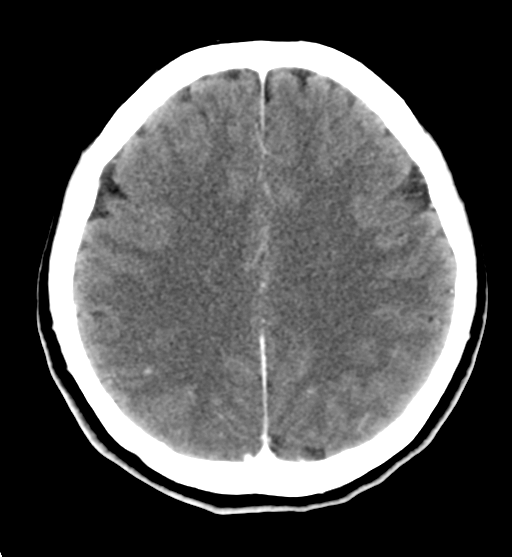 File:Cerebral cavernous venous malformations (Radiopaedia 48117-52945 Axial C+ delayed 23).png