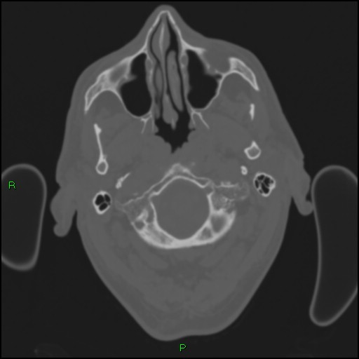 Cerebral contusions (Radiopaedia 33868-35039 Axial bone window 13).jpg