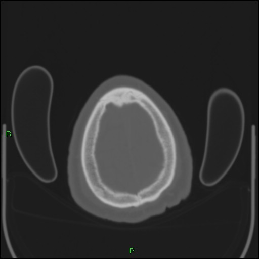 Cerebral contusions (Radiopaedia 33868-35039 Axial bone window 204).jpg