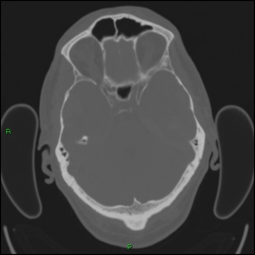 File:Cerebral contusions (Radiopaedia 33868-35039 Axial bone window 61).jpg
