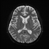 Cerebral embolic infarcts (embolic shower) (Radiopaedia 72391-82921 Axial DWI 16).jpg