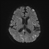 File:Cerebral embolic infarcts (embolic shower) (Radiopaedia 72391-82921 Axial DWI 47).jpg