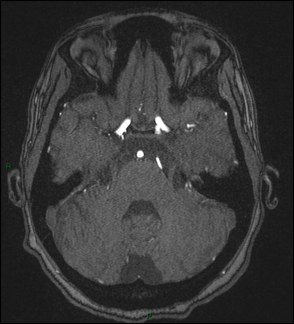 Cerebral fat embolism (Radiopaedia 35022-36525 Axial TOF 58).jpg