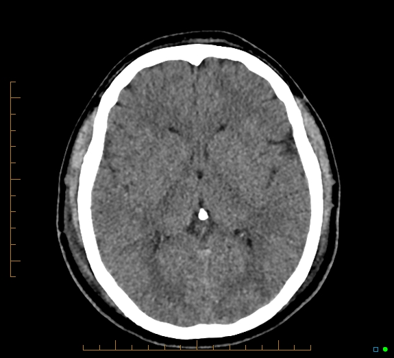 Cerebral fat embolism (Radiopaedia 85521-101224 Axial non-contrast 26).jpg