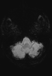 File:Cerebral hemorrhagic contusions- temporal evolution (Radiopaedia 40224-42757 Axial SWI 4).png